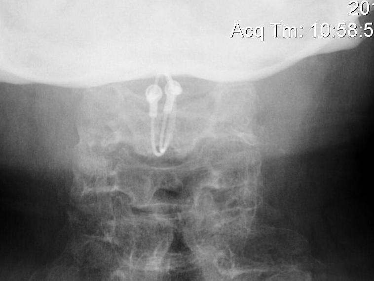 C1 C2 Posterior Spinous Process Wiring